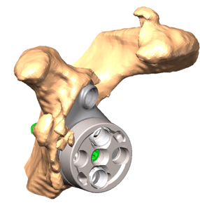 Glenoid Augment