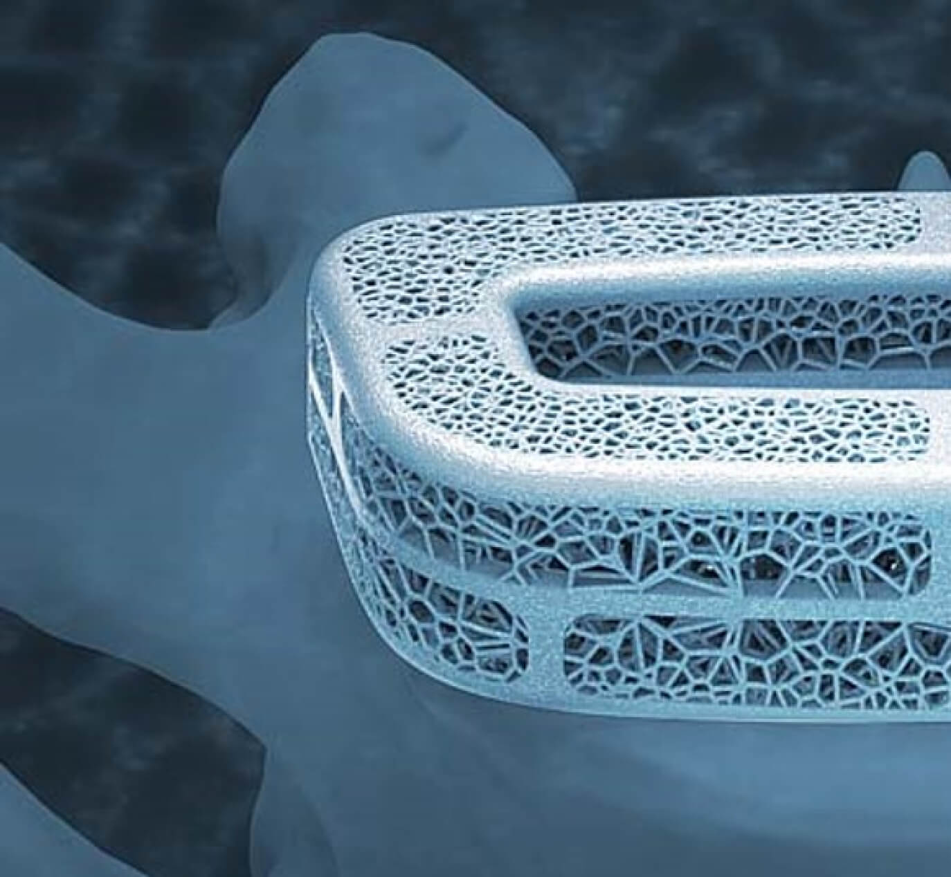 TiGraft Spine Cage 1(1)